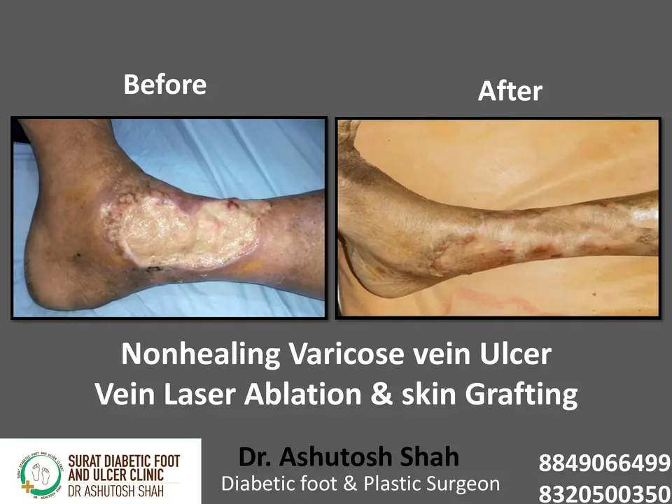 Varicose veins and Ulcers.pptx-9.webp